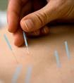 ACUPUNTURA